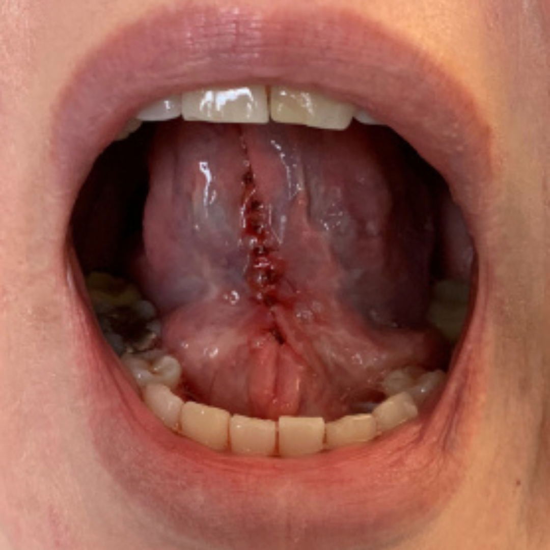 HEADNECK PRECANCER(26)